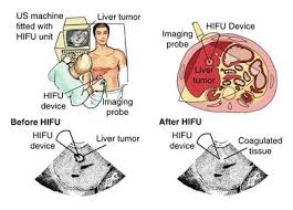 India Hifu Cancer Treatment Mumbai Indiahifu Treatment Liver Cancer