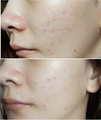 White out tape mineral life. Nano White Skincare Review Skinfrosting