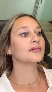 Understated lip filler is my newest obsession. That’s it. That’s the end of  the post. , #MedicalAesthetics #AntiAgingTreatments #NonSurgicalAesthetics  #SkinEnhancement #FaceInjectables ...