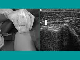 Image result for Biceps Tendon Injection