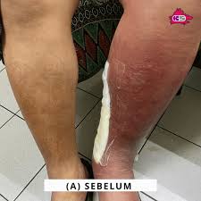 Candidiasis termasuk pelbagai jenis jangkitan, mulai dari permukaan tertinggi dan berakhir dengan tahap sistem. Cara Rawatan Cellulitis Jangkitan Pada Kulit Kaki Penghidap Kencing Manis Klinik Sabah