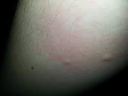 Plotzlich 2 Juckende Punkte Dort Mucken Stich Flohe