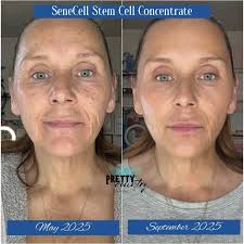Senecell skincare transformation results