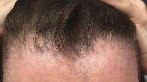 Hair loss while on propecia. Ru58841 For Hair Loss Underused Finasteride Alternative Hairverse