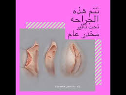 تصغير الشفرات الداخليه الكبيره والمترهله ليست عمليه تجميليه ولكنها علاج لمن تعاني من هذه المشكله youtube