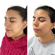 Resultados después de una sesión de peeling químico para acné 😍 Recuerden  que un protocolo completo es de 2 a 4 sesiones por lo que seguiremos  mejorando aún más la calidad de