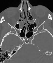 Ethmoid Sinus Abnormal