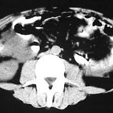 Accepted for inclusion in department of radiology faculty papers by an. Cystic Peritoneal Mesothelioma Eurorad