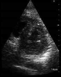 Most of the time, it is caused by an infection that reaches the heart. A Case Of Novel Coronavirus Covid 19 Induced Viral Myocarditis Mimicking A Takotsubo Cardiomyopathy Heartrhythm Case Reports