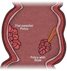 Check spelling or type a new query. Polyps Of The Colon And Rectum Ascrs