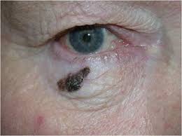 Learn more on advanced detection and treatments. Melanoma Of The Eyelid Springerlink