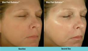 I think it is best to take a conservative approach and use repeated peels as opposed to a longer peel as this will decrease risk and the chance of a. Chemical Peels Radiance Medspa Woodbury St Paul Mn