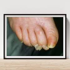 Image result for Onychogryphosis feet