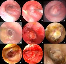 Image result for Myringosclerosis