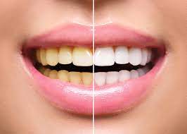 And that you are soon going to have a new smile with a their thinking is that they want their teeth to be in the best, brightest condition when the day finally arrives and their braces are removed. Teeth Whitening After Braces Belmar Orthodontics