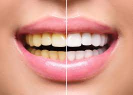 How does teeth whitening (bleaching) work? Teeth Whitening After Braces Belmar Orthodontics