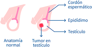Cancer De Testiculos Cancer Testicular Seminoma