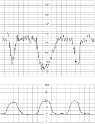 Image result for Early Deceleration
