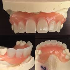 How much does partial teeth cost? Valplast Upper Flexible Partial No Metal Hypoallergenic Clasp Disappear In The Mouth Partial Dentures Dental Dentures