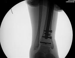 Fibula fractures are an injury to the smaller of the two bones that comprise the lower leg. Ankle Fractures Trauma Orthobullets