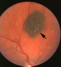 Nevus With Drusen Retinal Photography Medical Photography Eye Health