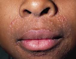 Perioral dermatitis — Medical Secrets