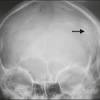 Osteosarcoma of the jaw bones represents a distinct group of lesions from the conventional type commonly occurring in long bones. Https Encrypted Tbn0 Gstatic Com Images Q Tbn And9gcsmuqdeic11 Tnvk9mac7cfwmg18js3rxt462p2of7irusakvhd Usqp Cau