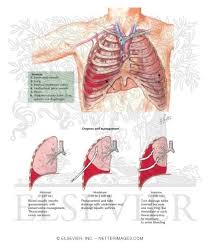 Image result for Hemothorax