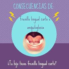 Fonoaudiologa Karla Sepulveda Zapata Tu Hijo Tiene El Frenillo Lingual Corto Una Forma De Observar Si Un Nino Tiene El Frenillo Lingual Corto Es Comprobando Que Cuando Saca La Lengua