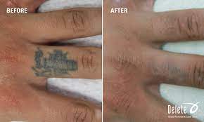 Here Is This Week S Before After Picoway Laser Tattoo Removal From The Docs At Delete Fingers Are The 1 Laser Tattoo Laser Tattoo Removal Tattoo Removal
