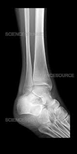 Image result for Ankle XRay