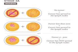 Breast cancer is stage 2a if one of these is true: Breast Cancer Hospital In Thane What Types Of Cancer Are Diagnosed As Stage 2 And 2a