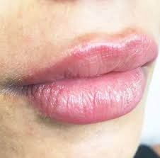 The related information of laser hair removal machine: Clearskin Clinics Toowong Brisbane City Brisbanebestbeauty