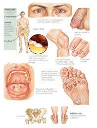 Check spelling or type a new query. Legends Of Surgery On Twitter Til Reactive Arthritis Aka Reiter S Syndrome Was Described In A Soldier By German Doctor Hans Reiter In 1916 Reiter Was A Nazi Joined The Ss And Killed