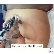 The perianal and buttocks can be done as one combined treatment. Buttocks Laser Hair Removal Glam Laser Beauty Studio