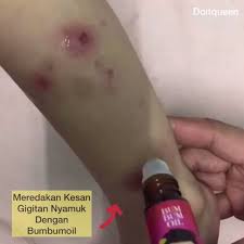 Dalam kebanyakan kes, gigitan semut tidak menimbulkan bahaya kepada manusia. Bumbumoilhq Instagram Posts Gramho Com