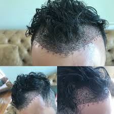 Il trapianto di capelli è l'operazione estetica più fatta dagli uomini. Genel Arsivleri Trapianto Di Capelli In Turchia