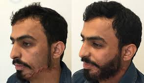 However, it will again depend on the size of the area that needs to be treated and the number of grafts required. Hair Transplant Ilht Dubai