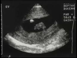 Image result for First Trimester Ultrasound