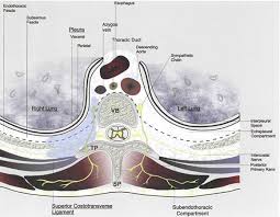 Image result for Intrapleural Anesthesia