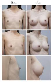 貧乳困擾水滴隆乳心得日記分享心路歷程公開- 乳房發育不良貧乳- - 削骨.隆鼻.抽脂.隆乳.拉皮台灣台北教主整形醫美頂尖權威醫師推薦