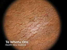 Image result for Ozoroa nigricans