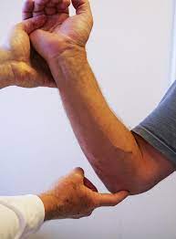 Swelling is the result of fluid buildup that gets trapped in your body's tissues. Ulnar Nerve Entrapment At The Elbow Cubital Tunnel Syndrome Orthoinfo Aaos