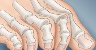What Your Feet Say About Your Health Foot Remedies Claw Toe Swollen Feet Remedy
