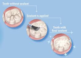 Brushing and flossing are the best ways to help prevent cavities, but it's not always easy to clean every in fact, sealants have been shown to reduce the risk of decay by nearly 80% in molars. School Sealant Programs Division Of Oral Health Cdc