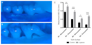 The mesiopalatal cusp is the largest cusp; Robust Ligature Induced Model Of Murine Periodontitis For The Evaluation Of Oral Neutrophils Protocol