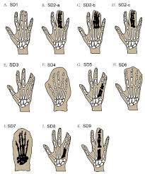 Image result for Syndactyly