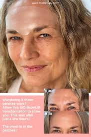 Folge deiner leidenschaft bei ebay! 31 Best Wrinkles Before And After Sio Patches Ideas In 2021 Chest Wrinkles Wrinkles Skin