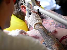 Tattoo Removal How To Costs Before And After Pictures More