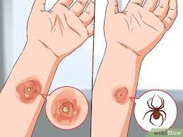 Kill mrsa in 30 sec. 4 Ways To Get Rid Of Mrsa Wikihow